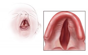 cleft_palate - CDC